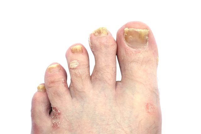 Lupenka může postihovat i nehty, Zdroj: Shutterstock.com