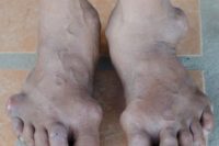 Pokročilé deformity nohou v důsledku dny