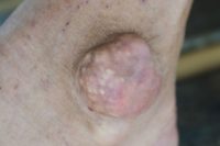 Nahromaděné krystalky