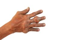 Deformity na rukou v pokročilé fázi dny