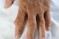 Deformity na rukou v pokročilé fázi dny