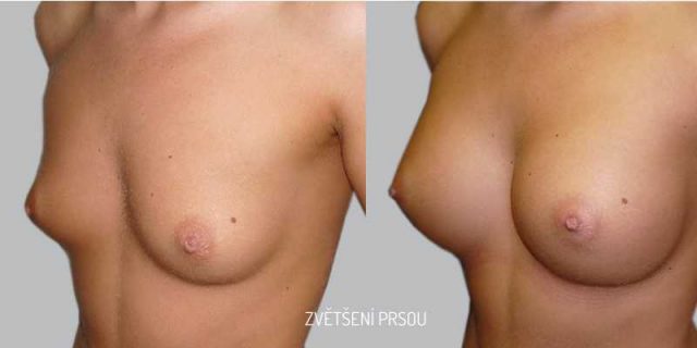 Před a po plastika prsou zvětšení