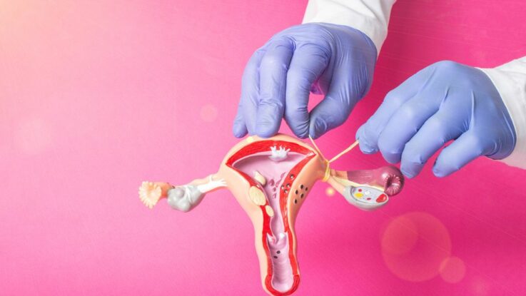 Sterilizace žen