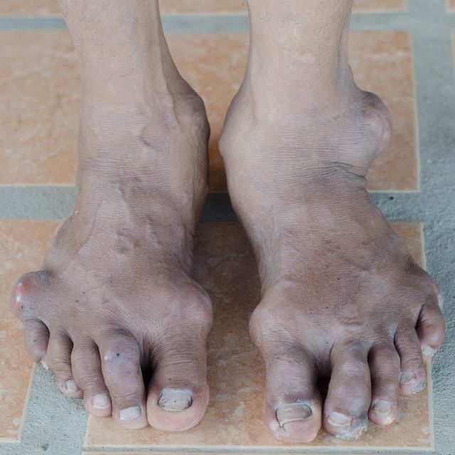 Pokročilé deformity nohou v důsledku dny