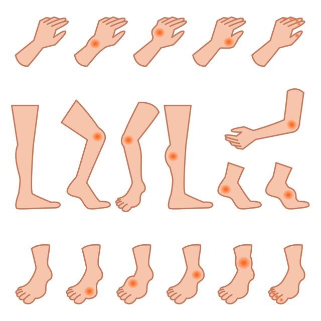 Nejčastější místa výskytu dny