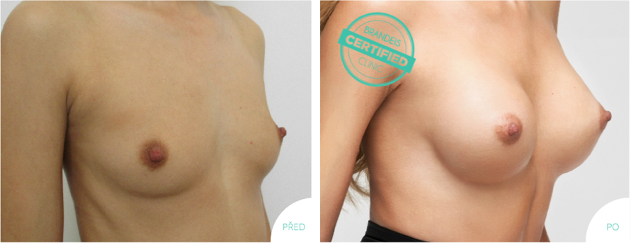 Plastická operace prsou před a po, Brandeis Clinic