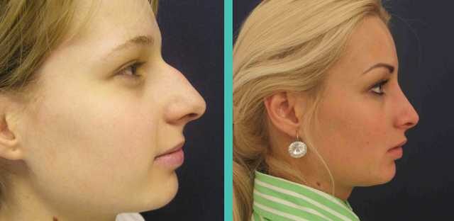 Plastická operace nosu před a po