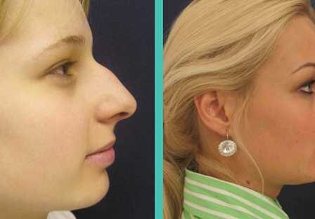 Plastická operace nosu před a po