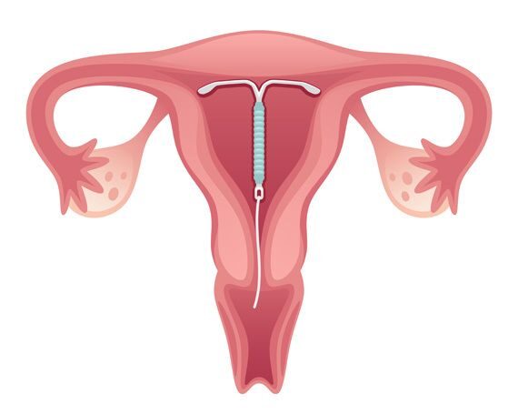 Nehormonální antikoncepce, nitroděložní tělísko