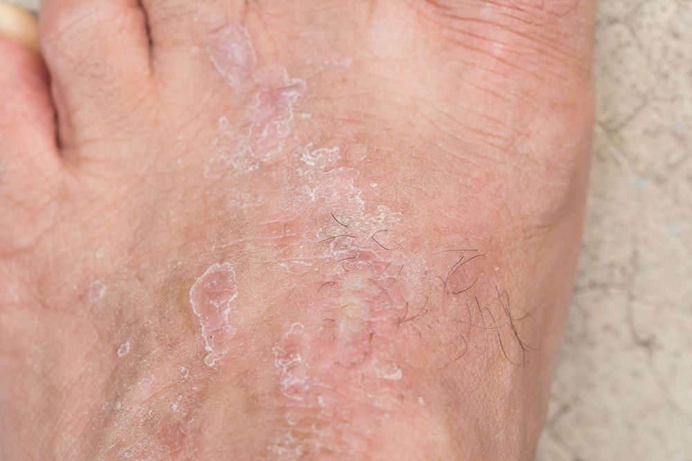 Plíseň a odlupující se kůže u atletické nohy