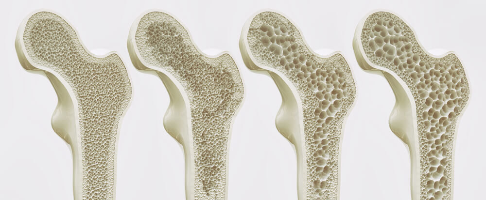 Osteoporóza