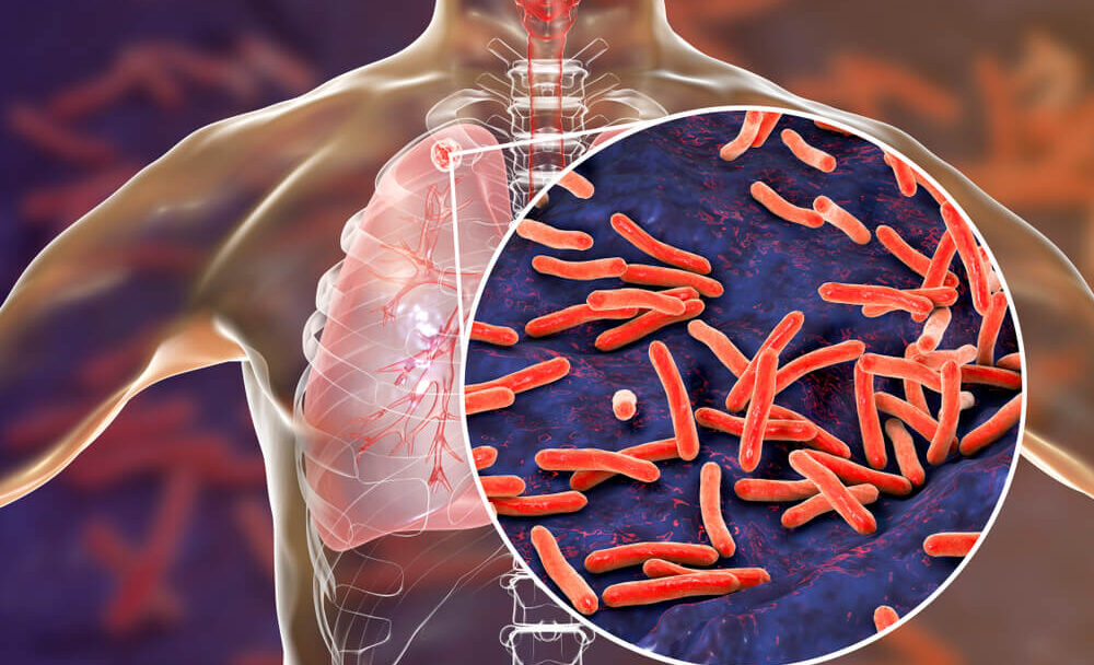 Souchotiny a tuberkulóza