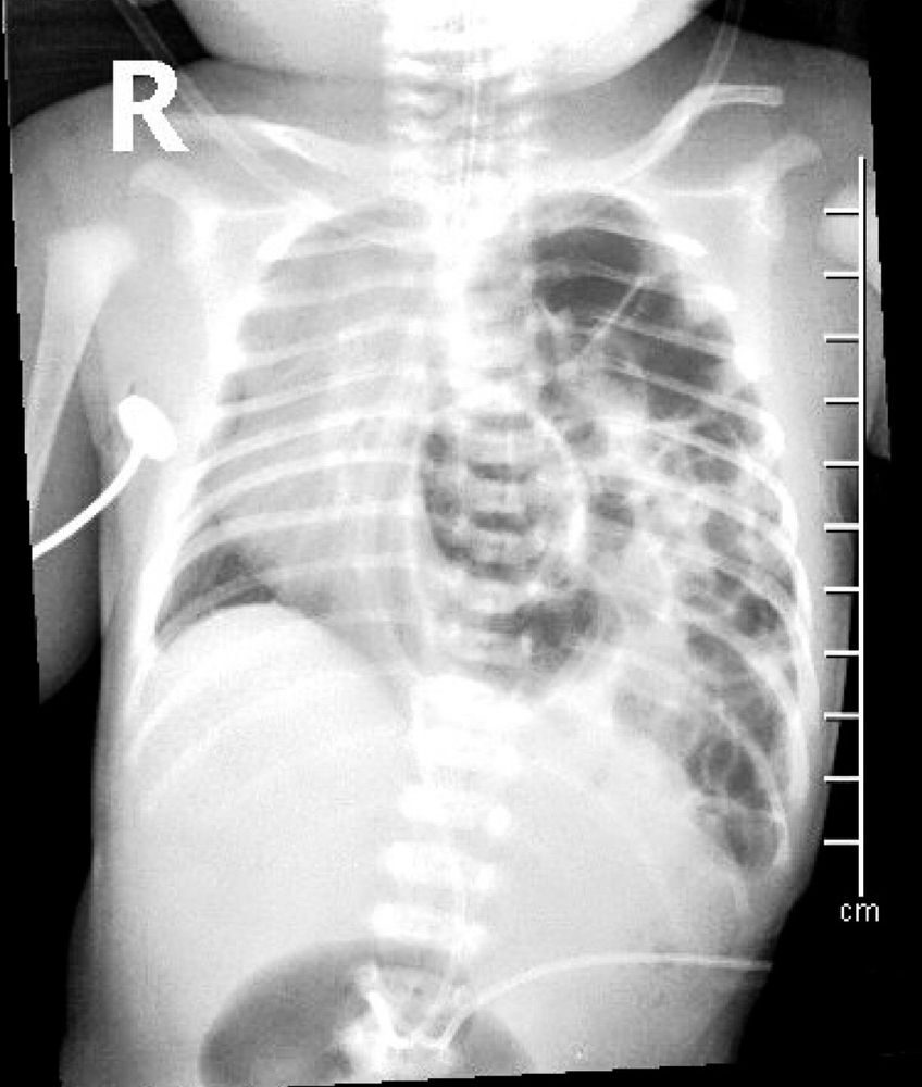 Brániční kýla u novorozence